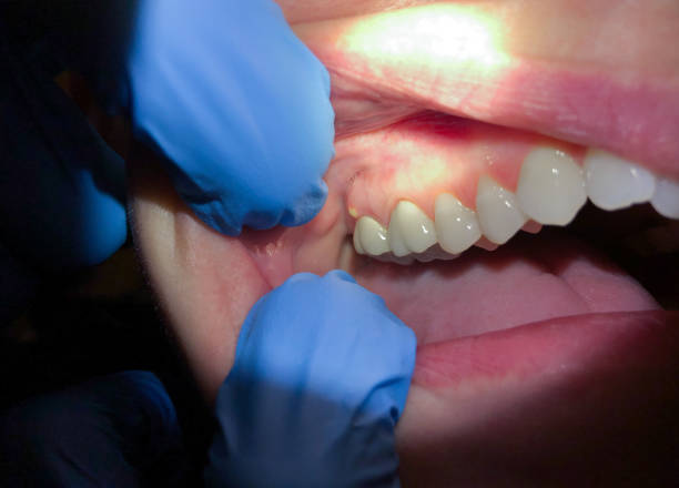 Best Emergency Dental Care for Broken or Chipped Teeth in Yorktown, TX
